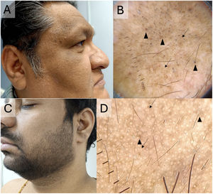 (A, B) Acanthosis nigricans in a Central American man. (A) Brownish macules with a velvety appearance predominantly on both cheeks and the supraciliary areas. (B) Dermoscopy shows a “sulci and gyri/cristae” pattern (black arrows) along with follicular plugs (black arrowheads). (C, D) Acanthosis nigricans in an Indian man. (C) Brownish velvety macules on the cheek. Note the acanthosis nigricans on the neck. (D) Dermoscopy shows a “sulci and gyri/cristae” pattern (black arrows).
