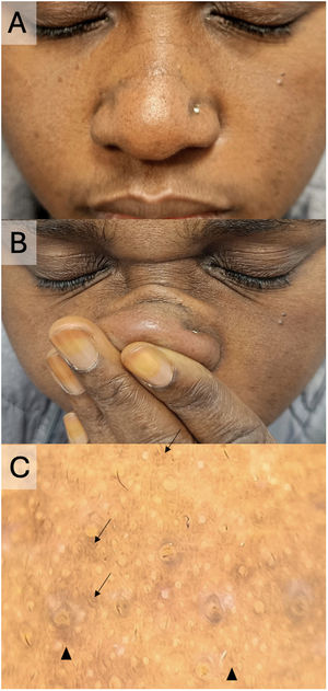 (A–C) Frictional melanosis secondary to allergic rhinitis in a 32-year-old African woman. (A) Hyperpigmented macules in the nasal region. (B) Repetitive gesture performed by the patient (frequent nasal rubbing). (C) Dermoscopy showing exaggeration of the facial pseudoreticular pattern (black arrows) and diffuse brown-gray dots/globules (black arrowheads).