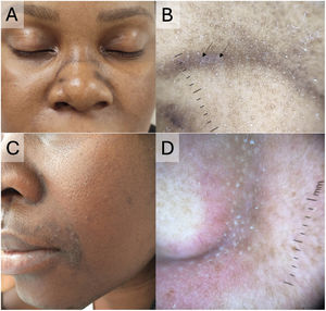 (A, B) Thirty-year-old African woman with hyperpigmented lesions in the nasolabial folds and alar grooves. (A) Dark-brown macules in the alar grooves and nasolabial folds. (B) Dermoscopy: whitish scales (black arrows), predominantly in the alar groove, with background hyperpigmentation. (C, D) Latin American woman with pigmentation in the nasal groove and perioral region due to seborrheic dermatitis. Dermoscopy of the nasal groove showed prominent follicular openings, mild scaling, telangiectasias, and diffuse pigment.