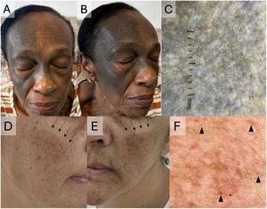(A–C) Nevus of Ota. (A) Blue-gray pigmented macule on the right hemiface, predominantly in the V1 and V2 territories. (B) Dermoscopy shows blue-gray coloration with light-brown and some lighter areas within the nevus. Photographs courtesy of Dr. Verónica Echeverry. (D–F) Lichen planus pigmentosus in a Latin American woman. (D–E) Grayish-brown macules affecting the entire face, predominantly on the cheeks (black arrows). (F) Dermoscopy shows perifollicular brown-gray dots and globules (black arrowheads) without obliteration of follicular openings.