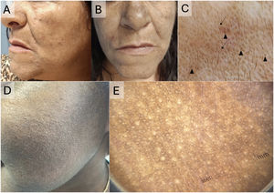 (A–C) Latin American woman with Riehl