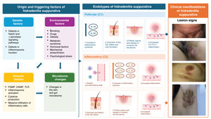 Triggering factors and pathogenesis of HS. CRP: C-reactive protein; DAMP: damage-associated molecular patterns; PAMP: pathogen-associated molecular patterns; TLR: toll-like receptors.