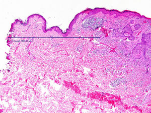 Image of the surgical specimen resected with an electrosurgical scalpel after H&E staining. The line represents the distance between the lateral edge of the tumor and the lateral resection edge, that is, the resection margin. Of the two resection margins resulting from transverse sectioning of the surgical specimen, only the closest margin was included in all cases. Note the coagulative necrosis in the form of an irregular eosinophilic band generated by the ultrafine-tip electrosurgical scalpel.