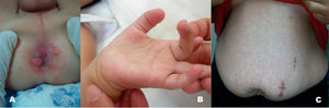 (A) Condyloma lata in the perianal region of patient #1 (index case). (B) Nonpruritic erythematous micropapular rash on the palms of patient #1 (index case). (C) Lesion in the mother (patient 4), consisting of a nonpruritic erythematous micropapular rash on the trunk corresponding to secondary syphilis.