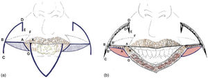 (a) Flap design; horizontal incision performed from the labial commissure to the nasolabial fold. (b) Exposure of the orbicularis muscle; incision performed from the nasolabial fold to the intersection of the resection incision and the vermilion; resection of skin and SCT of the triangle intended for placement of new labial mucosa derived from buccal mucosa; incision toward the root of the nasolabial fold.