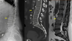 (a) Radiographic image showing collapse of the L2–L3 vertebral space. (b) Sagittal CT scan demonstrating the abovementioned collapse and erosion of the vertebral endplates of L2 and L3. (c) Sagittal MRI T2-weighted sequence showing phlegmonous changes at the level of the intervertebral disc and adjacent soft tissues.