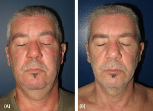 Facial lesions of DM during treatment with tofacitinib (A) and after four doses of anifrolumab (B).