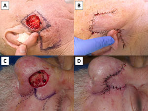 Two monolobed transposition flaps used to reconstruct surgical defects: one with linear geometry (Limberg flap) (A and B) and the other with curvilinear geometry (banner flap) (C and D). The reconstructive concept is similar in both techniques, with the principal difference being the greater amount of healthy tissue sacrificed with the linear flap.