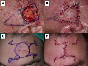 (A and B) A Mohs micrographic surgery wound reshaped from a circular to a square configuration to accommodate the linear geometry of a classic island advancement flap. (C and D) An H-flap modified into an SH-flap to minimize sacrifice of healthy tissue, resulting in a final vertical scar with an S-shaped appearance.