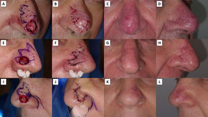 Demonstration of the possibility of designing a bilobed flap with either linear or curvilinear geometry. (A and D) Bilobed flap used to reconstruct a Mohs micrographic surgery wound on the nasal tip. The classic curvilinear design was squared off, requiring sacrifice of healthy tissue to adapt the rounded Mohs defect to the squared flap. Favorable aesthetic results were observed at 1 month, without trapdoor deformity. (E–H) Mohs micrographic surgery wound located on the alar sulcus repaired with a bilobed flap. In this case, the defect and the first lobe were triangularized to align with the Burow triangle of the second lobe. At 1-month follow-up, the aesthetic outcome was favorable, with mild hypertrophic scarring on the first lobe secondary to tip epidermal necrosis. No trapdoor deformity developed. (I–L) A curvilinear bilobed flap selected to reconstruct a Mohs micrographic surgery wound between the nasal tip and ala. At 1-month follow-up, a mild trapdoor deformity was evident and required two intralesional triamcinolone acetonide injections for resolution.