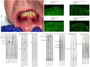 Results of case report #3. Clinical image, indirect immunofluorescence on normal skin (IIF) and NaCl-split skin (ss-IIF), and immunoblotting (IB). (A) Clinical image showing desquamative and erosive lower perialveolar gingivitis, as well as oral and gingival mucosal synechiae with loss of the lingual frenulum. (B) Standard IIF and ss-IIF images: standard IIF shows IgA deposition along the basement membrane zone (BMZ); ss-IIF shows IgG and IgA deposition on the epidermal roof. (C) IB images performed on the patient