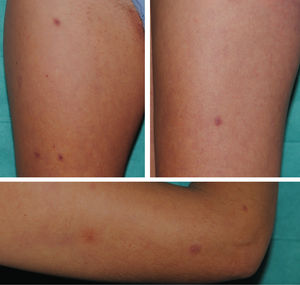 Clinical image of the lesions. Millimetric erythematous–violaceous papules distributed on the patient