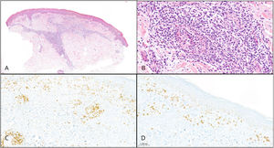 Histological image of the lesions. (A) Hematoxylin and eosin (H&E), 100×. A predominantly lymphocytic dermal inflammatory infiltrate with a perivascular distribution can be observed. (B) Detail of angiocentricity, H&E, 500×. (C) CD3 immunohistochemistry, 300×. (D) CD30 immunohistochemistry, 300×.