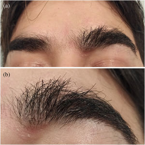 (A) A 2-cm tuft of hair in the body of the left eyebrow distorting its normal anatomical morphology. (B) Detail of the unnatural area, showing multiple and thick-diameter follicular units, as well as aberrant directions, angulations, and curvatures of the shafts.