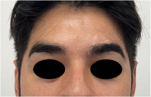 One year after surgery, the patient has a normal-appearing left eyebrow that is symmetrical to the contralateral eyebrow.
