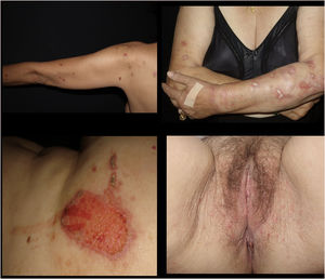 Skin lesions presented by the patients.