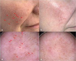 Spinulate demodicosis. (A and B) Papules with fine scaling, with Demodex tails visible on dermoscopy in follicular openings. (C and D) Therapeutic response after 1% ivermectin cream for 6 weeks and one PDL laser session – parameters: 10mm, 0.5ms, 6–7J/cm2.
