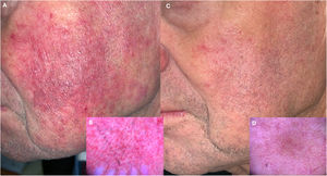 Papulopustular rosacea-like demodicosis. (A and B) Papulopustular rosacea-like demodicosis on the cheeks. Dermoscopy shows Demodex tails in follicular openings with the presence of an isolated pustule. (C and D) Therapeutic response after 1% ivermectin cream for 6 weeks and one PDL laser session – parameters: 10mm, 0.5ms, 6–7J/cm2.