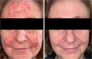 Pustulocystic rosacea-like demodicosis. (A and B) Pustulocystic rosacea-like demodicosis on the cheeks and forehead. (B) Therapeutic response after isotretinoin 5mg/day for 2 months and one PDL laser session – parameters: 10mm, 0.5ms, 6–7J/cm2.
