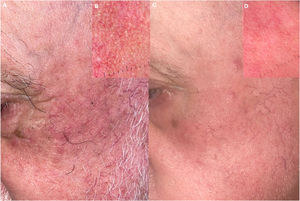 Plaque demodicosis. (A and B) Asymmetric plaque demodicosis with fine scaling and underlying telangiectasias. Dermoscopy shows Demodex tails in follicular openings. (C and D) Therapeutic response after 1 session of KTP 532-nm laser – parameters: 10mm, 10ms, 7–10J/cm2.
