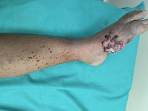 Clinical photograph of a patient presenting with multiple erythematous and blackish papules and nodules on the lower extremity, corresponding to “satellite” metastases (within 2cm of the primary tumor) and “in-transit” metastases (>2cm from the primary tumor toward the corresponding lymph node).
