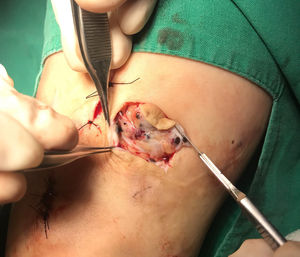 Metastasectomy. Multiple in-transit lesions are observed at the periphery of the incision within the subcutaneous tissue.