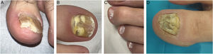 OM patterns. (A) Distal and lateral subungual OM. (B) Proximal OM. (C) Superficial white OM. (D) Dystrophic OM.