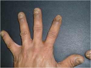 Fingernail OM, crumbling subtype caused by Aspergillus niger.