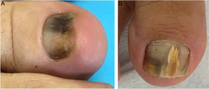 (A) Fungal melanonychia. (B) Dermatophytoma.
