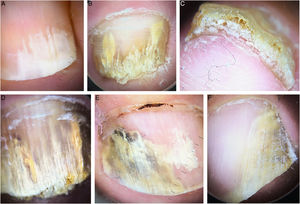 Dermoscopy. (A) Onycholysis with an irregular spiked border. (B) Longitudinal streaks, onycholysis with an irregular border, dermatophytoma, irregular termination. (C) Ruin pattern. (D) “Aurora borealis” sign. (E) Onycholysis with an irregular spiked border. (F) Smooth onycholytic border.