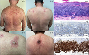 (A–D) Infiltrated, scaly, erythematous plaques located on the upper back. (E) Skin biopsy showing a granulomatous inflammatory infiltrate. (F, G) IHC showing inversion of the CD4/CD8 ratio, with a marked predominance of CD8+ lymphocytes.