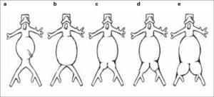 Clasificación de los aneurismas de aorta abdominal propuesta por el registro EUROSTAR según el grado de afectación de los ejes ilíacos. En los tipos A, B y C, las ramas ilíacas de la endoprótesis se pueden anclar en la ilíaca común respetando su bifurcación. En el tipo D, la zona de anclaje en la ilíaca común puede no ser suficiente y dependerá de las condiciones anatómicas para hacer necesaria la exclusión de la arteria hipogástrica. En el tipo E, el anclaje en la ilíaca externa y la exclusión de la arteria hipogástrica son obligatorios (modificado de [14] y [16]).