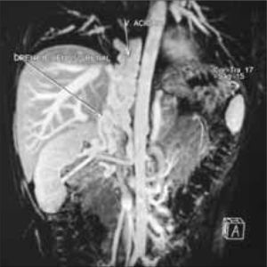 Angiorresonancia magnética: las venas renales bilaterales forman un conglomerado de venas varicosas que desemboca en un sistema hipertrofiado de las venas ácigos y hemiácigos.