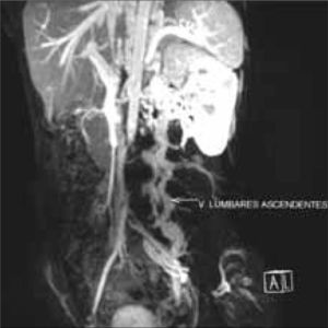 Angiorresonancia magnética: hipertrofia de venas lumbares.