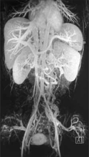 Angiorresonancia magnética: hipoplasia de la vena cava inferior perirrenal. En las venas suprahepáticas y el eje esplenoportal no hay hallazgos patológicos.