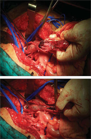 Imagen intraoperatoria de la vena gonadal hipertrofiada trombosada.