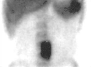 Gammagrafía con leucocitos marcados con 99mTc-HMPAO: intenso acúmulo patológico en la zona de la prótesis vascular aórtica abdominal, compatible con infección.