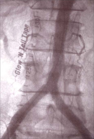 Resultado angiográfico intraoperatorio tras angioplastia transluminal + implante de endoprótesis Hemobahn®: sin estenosis residual, con arteria mesentérica inferior permeable y bifurcación aórtica indemne.
