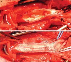 Procedimiento quirúrgico femoral: a) Placa blanda, compleja, coraliforme en la AFC; b) Superficie de la AFC tras la endarterectomía.