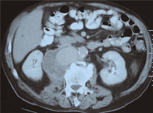 Tomografía computarizada: gran aneurisma de aorta abdominal de morfología sacular, con trombo mural y erosión de la vértebra lumbar.