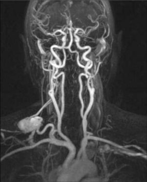 Angiorresonancia magnética que demuestra la existencia de un pseudoaneurisma del tronco tirocervical.