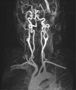 Angiorresonancia magnética realizada a los tres meses del tratamiento, donde se observa la desaparición del pseudoaneurisma tratado.