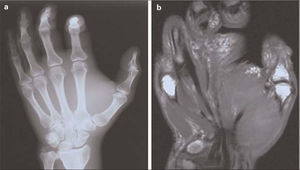 a) Radiografía simple de la mano: aumento de partes blandas; b) Resonancia magnética (RM) de partes blandas de la extremidad superior izquierda: signos inflamatorios inespecíficos en la musculatura tenar e interósea y en el tejido celular subcutáneo, sin visualizarse abscesos.