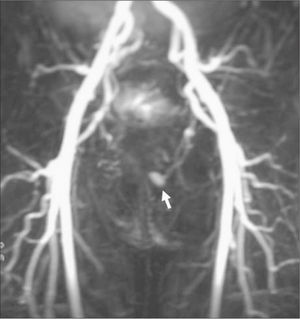 Angiorresonancia donde se aprecia la presencia de una fístula arteriovenosa unilateral en el cuerpo cavernoso izquierdo.