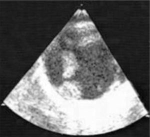 Ecocardiograma transesofágico que muestra un trombo adherido a la pared de la aorta y otro flotando en su luz.
