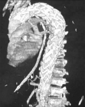 Endoprótesis desde la arteria subclavia izquierda hasta 2cm por encima del ostium del tronco celíaco.