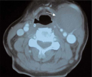 Tomografía computarizada: aneurisma trombosado de vena facial izquierda (flecha).