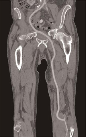 Angiotomografía, corte sagital, en la que se observa injerto protésico por el agujero obturador izquierdo y acceso retroperitoneal derecho.