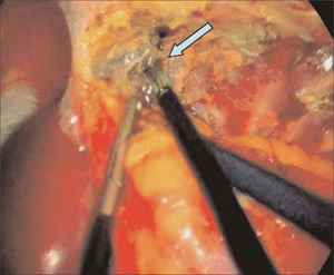 Disección profunda por fascia retrorrenal (flecha).