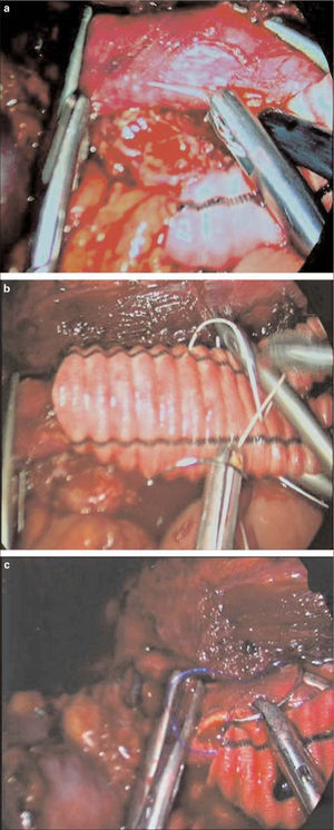 a) Clampaje aórtico y aortotomía con tijera de Potts laparoscópica; b) Inicio de la sutura, con punto de fijación y anudado intracorpóreo. c) Hemisutura posterior anudada sobre pledget con polipropileno 3/0.